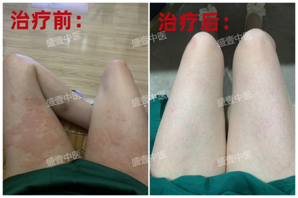 荨麻疹.png