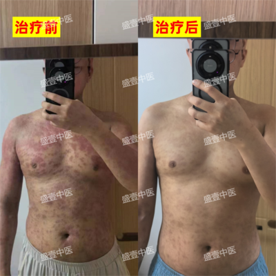 湿疹-全身对比1231水印.png